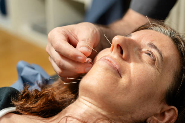 Acupuncture for Pain Management